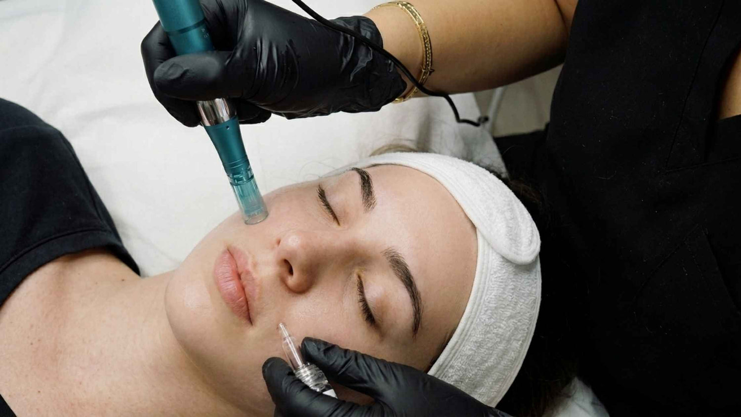 A woman receiving a microneedling facial